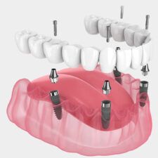 Essential Recovery Guidance Following All-on-4 Dental Implants